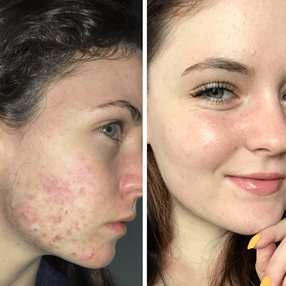Reactive Redness Anti-Ageing Routine for Redness + Breakout Prone Skin l RAWKANVAS ...