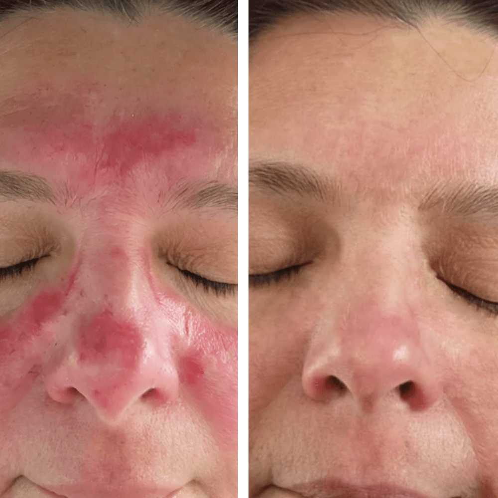 Reactive Redness Anti-Ageing Routine for Redness + Breakout Prone Skin l RAWKANVAS ...