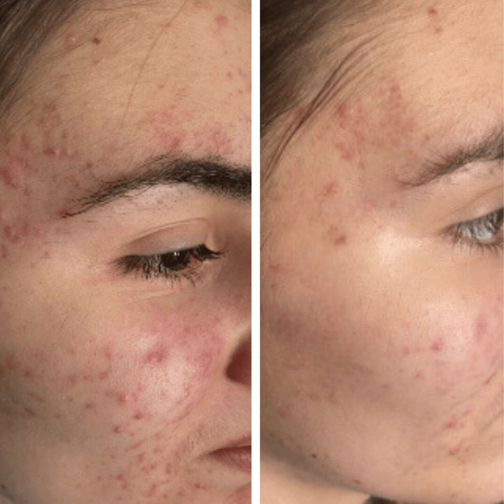 Breakout Routine Breakout Prone AM PM Routine for Breakout Prone Skin l RAWKANVAS ...