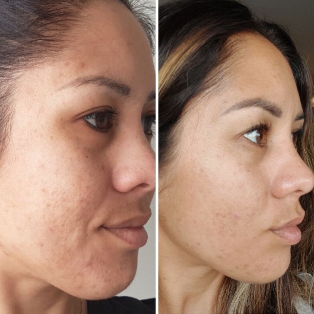Breakout Routine Breakout Prone Simple Routine for Breakout Prone Skin l RAWKANVAS ...