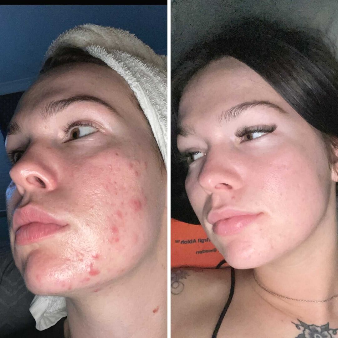 Breakout Routine Breakout Prone Simple Routine for Breakout Prone Skin l RAWKANVAS ...