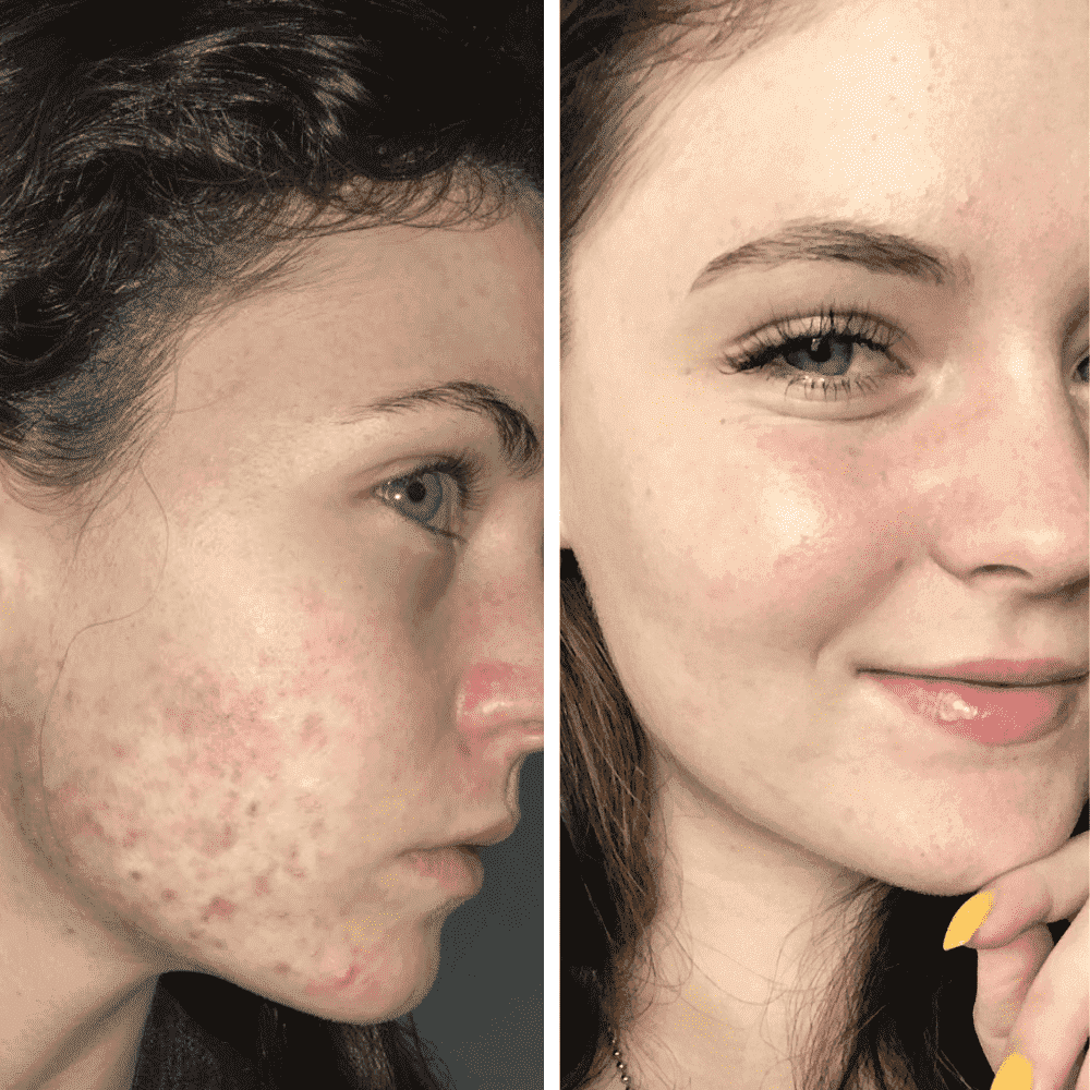 Breakout Routine Breakout Prone Simple Routine for Breakout Prone Skin l RAWKANVAS ...