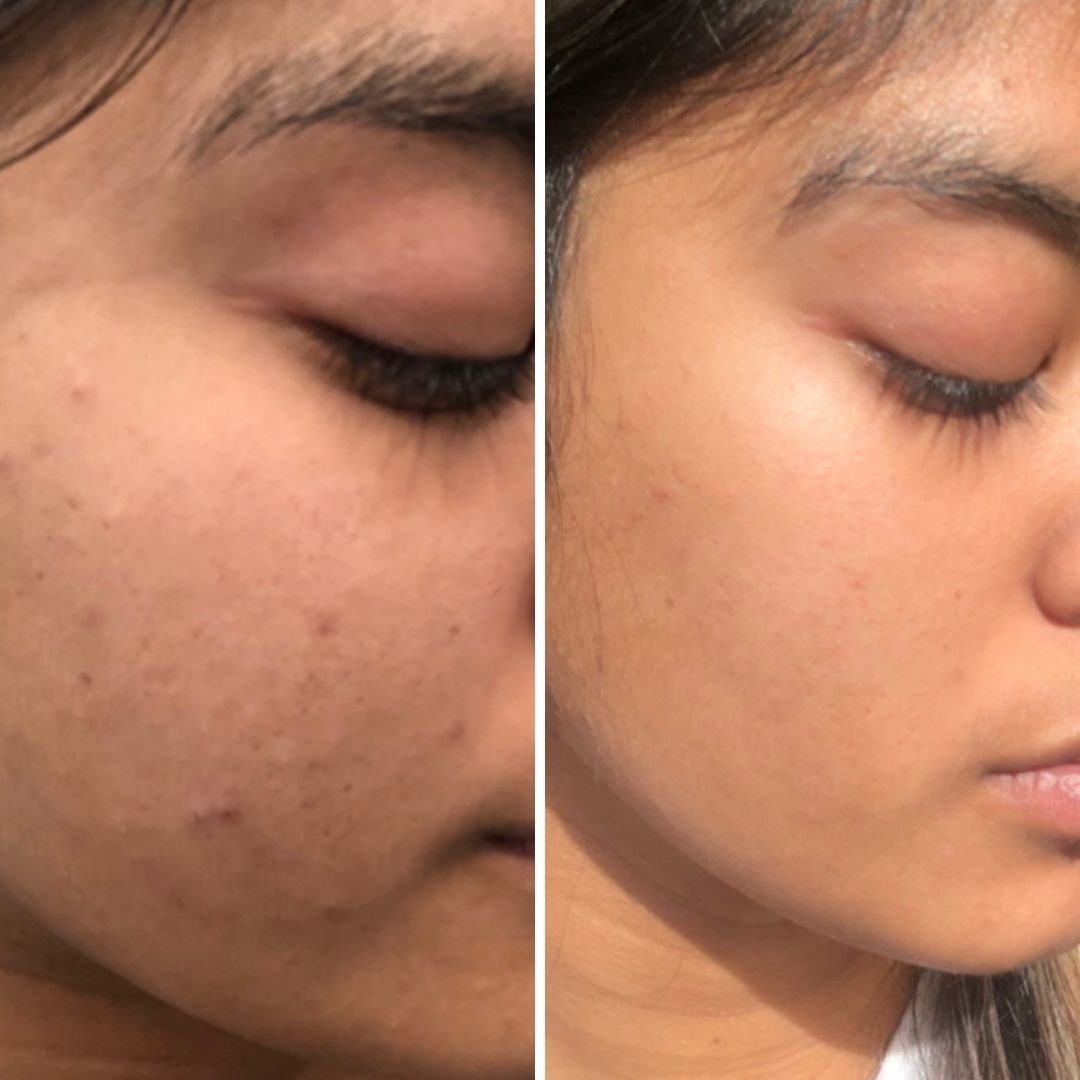 Breakout Routine Breakout Prone Simple Routine for Breakout Prone Skin l RAWKANVAS ...
